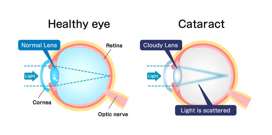 June is Cataract Awareness Month: What You Should Know About Cataracts, Surgery, and Reading Glasses
